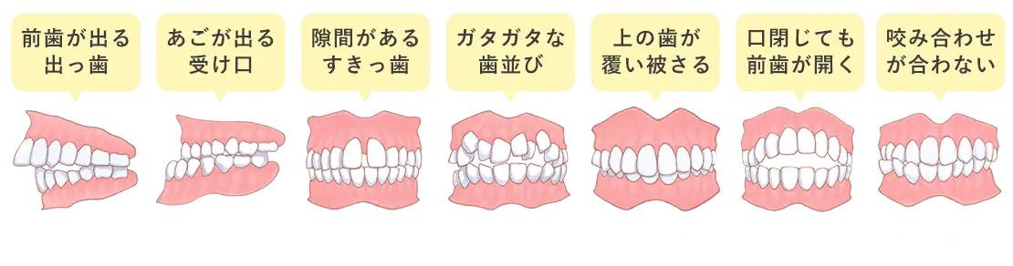 悪い歯並び
