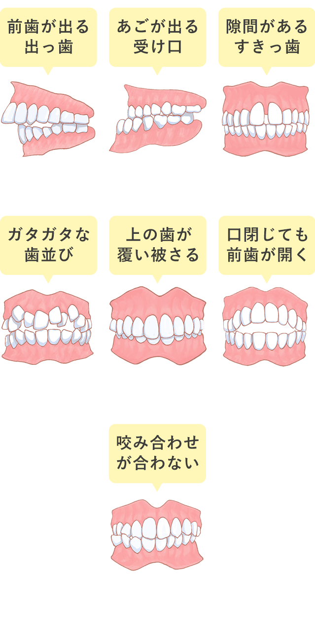 悪い歯並び