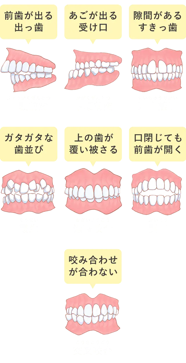 悪い歯並び