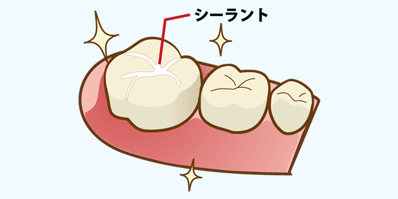 シーラント