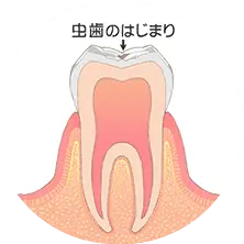 歯の表面の脱灰