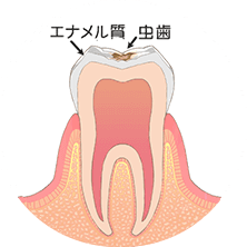 歯の表層（エナメル質）の虫歯