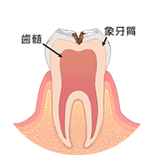 歯の中（象牙質）まで進んだ虫歯