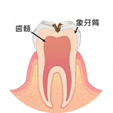 歯の中（象牙質）まで進んだ虫歯