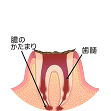 歯の根っこまで達した虫歯