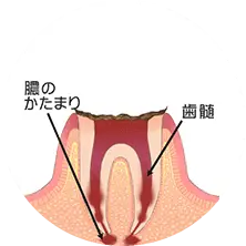 歯の根っこまで達した虫歯