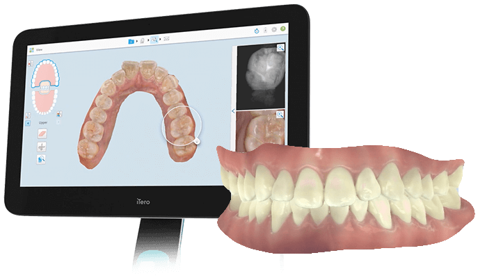 口腔内光学スキャナ iTero(アイテロ)