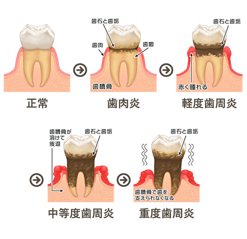 歯周病の進行