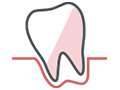 歯周病治療