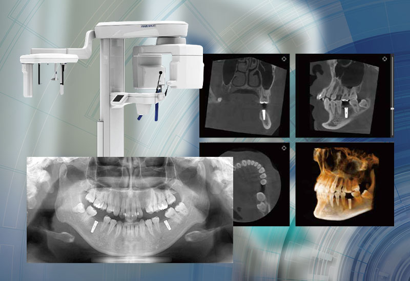 歯科用CTによる精密検査