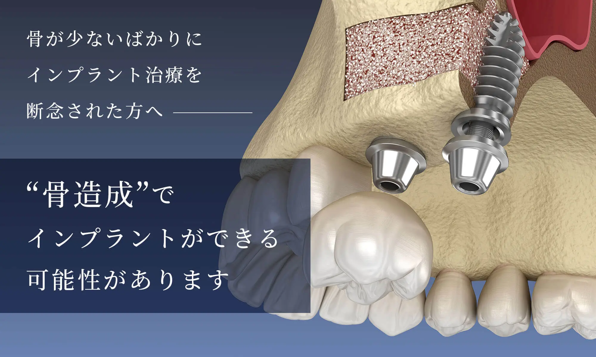 藤が丘 インプラント