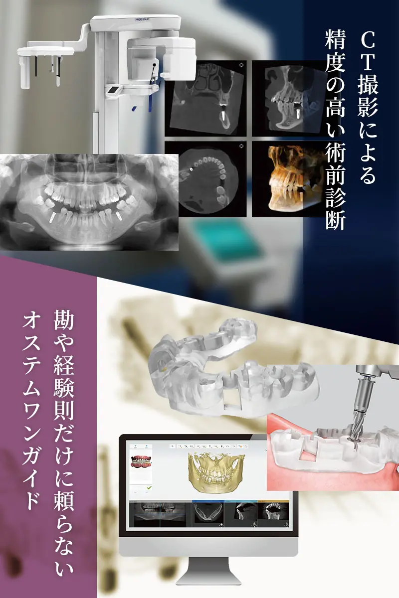 長久手市 インプラント